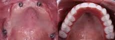 Implante Dentario em Uberlandia  Implante de dente  Extracao de siso  extrir dente siso  colocar dente em Uberlandia  implante dental em Uberlandia  protese dentaria - cirurgiao dentista - Dr Leandro Diniz