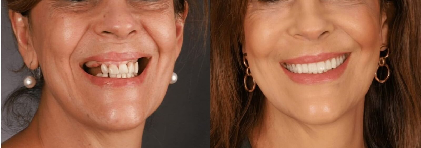 implante feminino